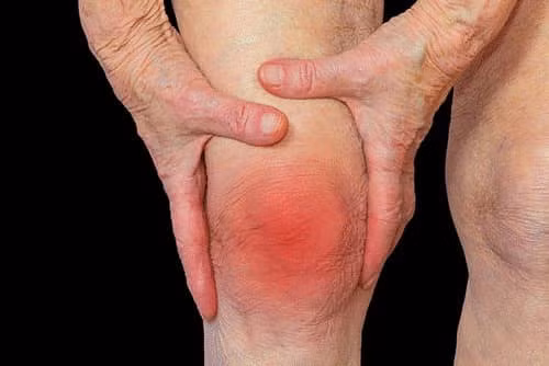 Tràn dịch khớp gối gây đau đớn khó chịu khớp gối