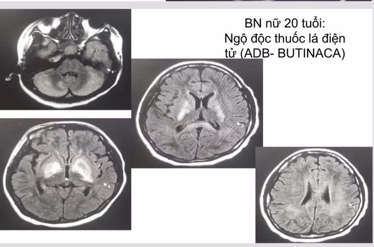 Hình ảnh não bệnh nhân bị tổn thương nặng do thuốc lá điện tử