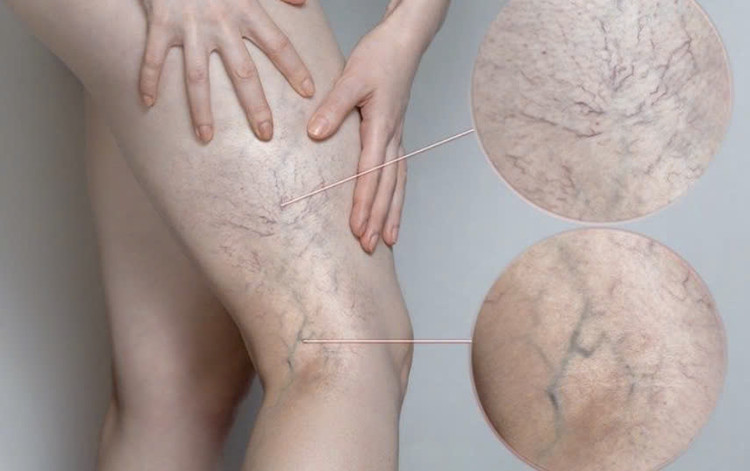 1/3 người trưởng thành bị suy giãn tĩnh mạch - Ảnh minh họa