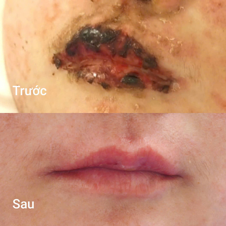 Tổn thương niêm mạc miệng trước và sau điều trị - Ảnh BVCC