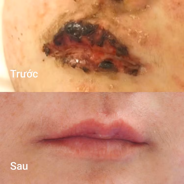 Tổn thương niêm mạc miệng trước và sau điều trị - Ảnh BVCC