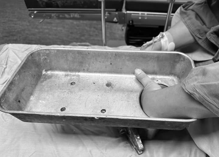 Người đàn ông nhập viện với bàn tay vẫn còn trong máy xay thịt - Ảnh: BVCC