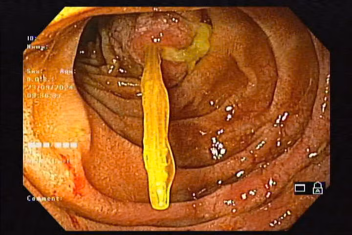 Liên tiếp nhiều người cấp cứu vì... nuốt tăm tre đâm thủng dạ dày, tá tràng ảnh 2