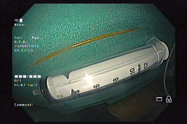 Liên tiếp nhiều người cấp cứu vì... nuốt tăm tre đâm thủng dạ dày, tá tràng ảnh 3