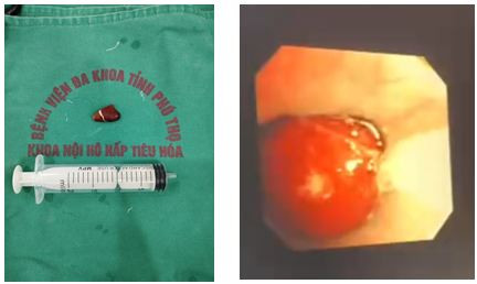 Dị vật hạt hồng xiêm được lấy ra từ phế quản bệnh nhân