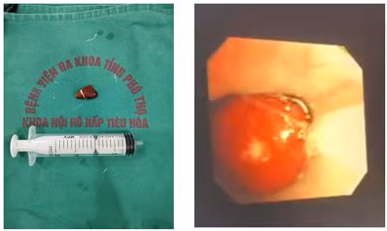 Dị vật hạt hồng xiêm được lấy ra từ phế quản bệnh nhân