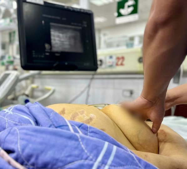 Bệnh nhân viêm gan B biến chứng suy gan, phù toàn thân - Ảnh BVCC