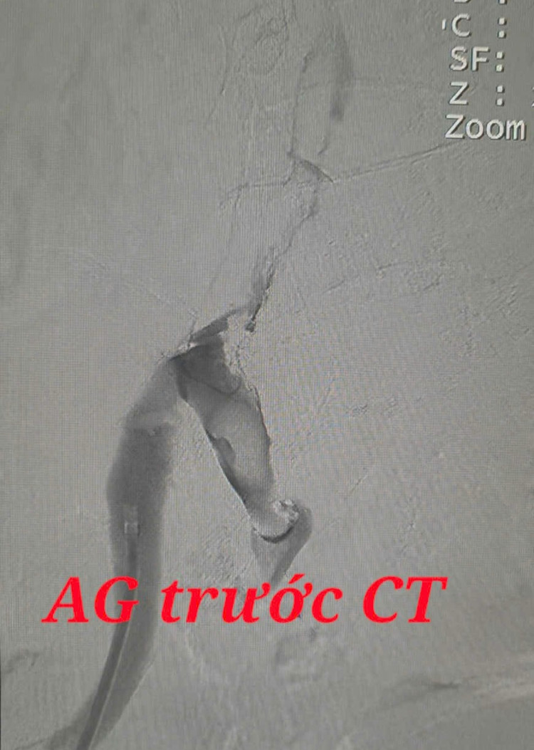 Kết quả chụp CT bệnh nhân bị tắc nghẽn mạch máu tĩnh mạch chậu - đùi cấp - Ảnh BVCC