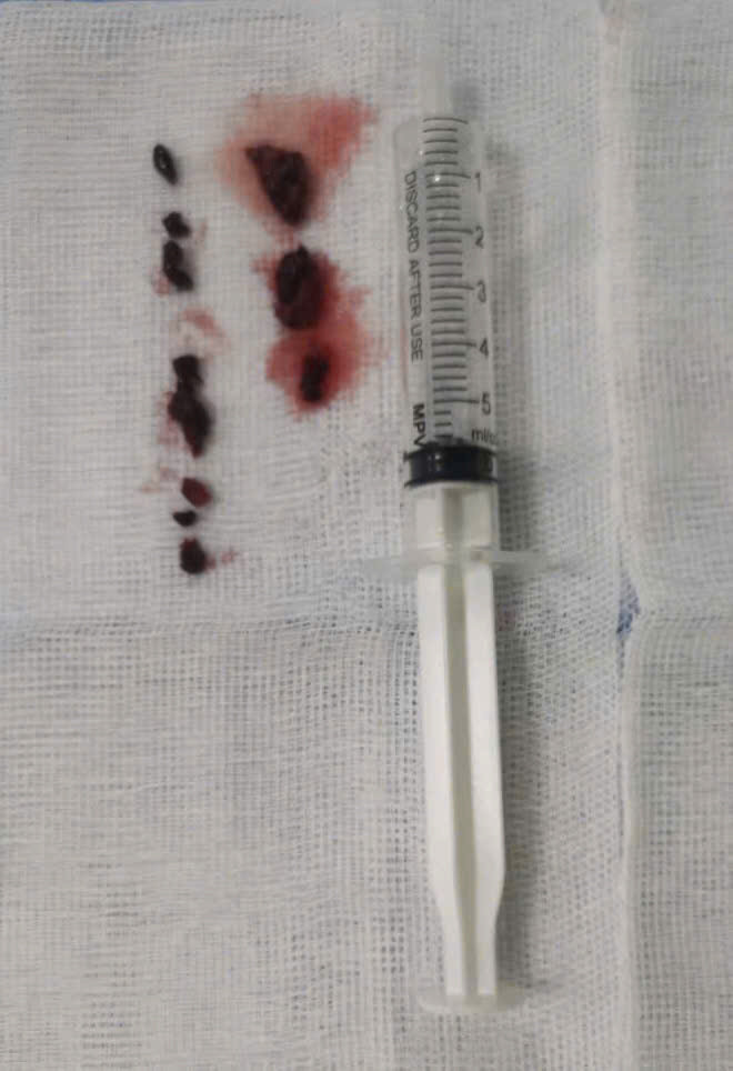 Huyết khối được lấy ra từ chân bệnh nhân - Ảnh BVCC