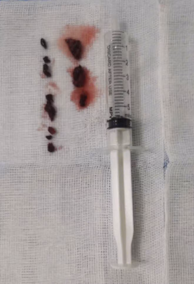 Huyết khối được lấy ra từ chân bệnh nhân - Ảnh BVCC