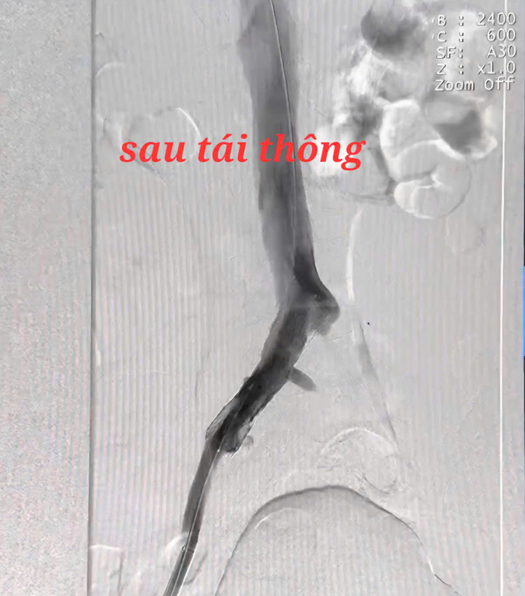 Sau tái thông mạch máu - Ảnh BVCC