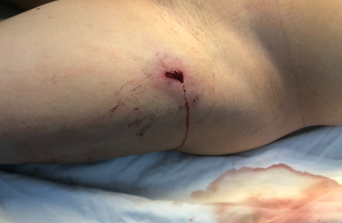 Vết thương tại đùi của bệnh nhân