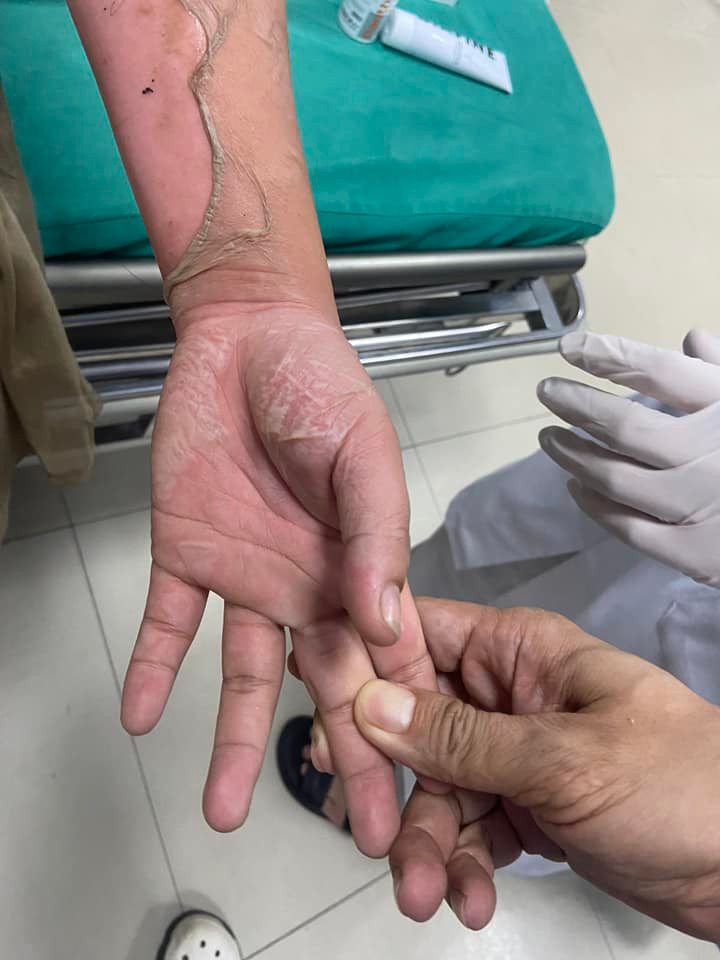 Dùng cồn nướng thức ăn nữ bệnh nhân 26 tuổi bỏng nặng ảnh 3