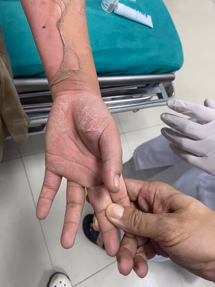 Dùng cồn nướng thức ăn nữ bệnh nhân 26 tuổi bỏng nặng ảnh 3