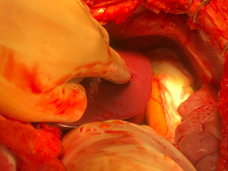 Hình ảnh vết thương tại gan