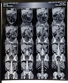 Lấy đạn xuyên thấu bụng, thủng gan và đùi cho chiến sĩ công an ảnh 3