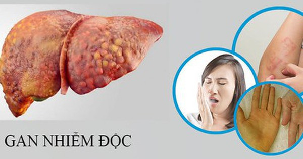 Đối tượng có nguy cơ mắc viêm gan nhiễm độc cấp ảnh 1