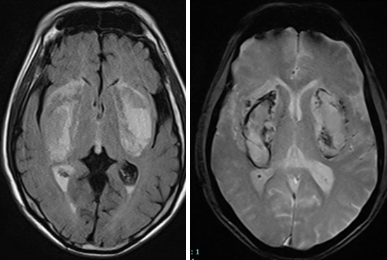 Hình ảnh tổn thương nhồi máu, chảy máu nhân bèo hai bên ở người bệnh ngộ độc Methanol do uống cồn giả pha nước