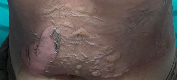 Bệnh nhân bị bỏng cồn nặng