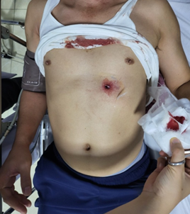 Lấy đạn xuyên thấu bụng, thủng gan và đùi cho chiến sĩ công an ảnh 2