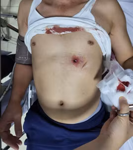 Lấy đạn xuyên thấu bụng, thủng gan và đùi cho chiến sĩ công an ảnh 2