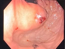 Ảnh: Vị trí tổn thương phình vị trong dạ dày của người bệnh - Ảnh BVCC