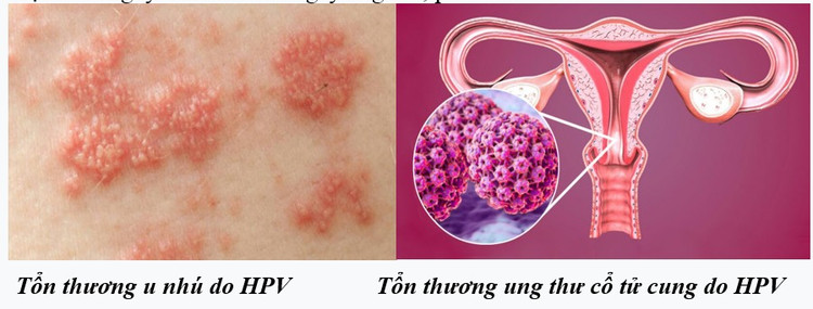 Chuyên gia mách cách phòng ngừa virus HPV gây nhiều bệnh ung thư ở người ảnh 1