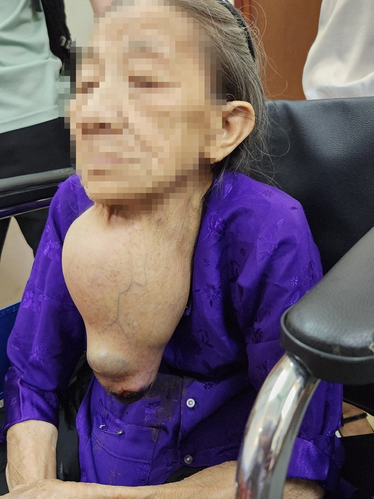 Khối bướu giáp khổng lồ ở cụ bà 92 tuổi