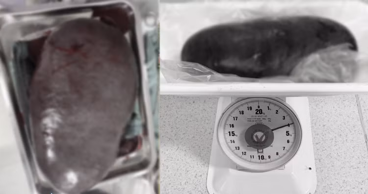 Hy hữu: Lách khổng lồ nặng 4kg chiếm hơn nửa ổ bụng quý ông 61 tuổi