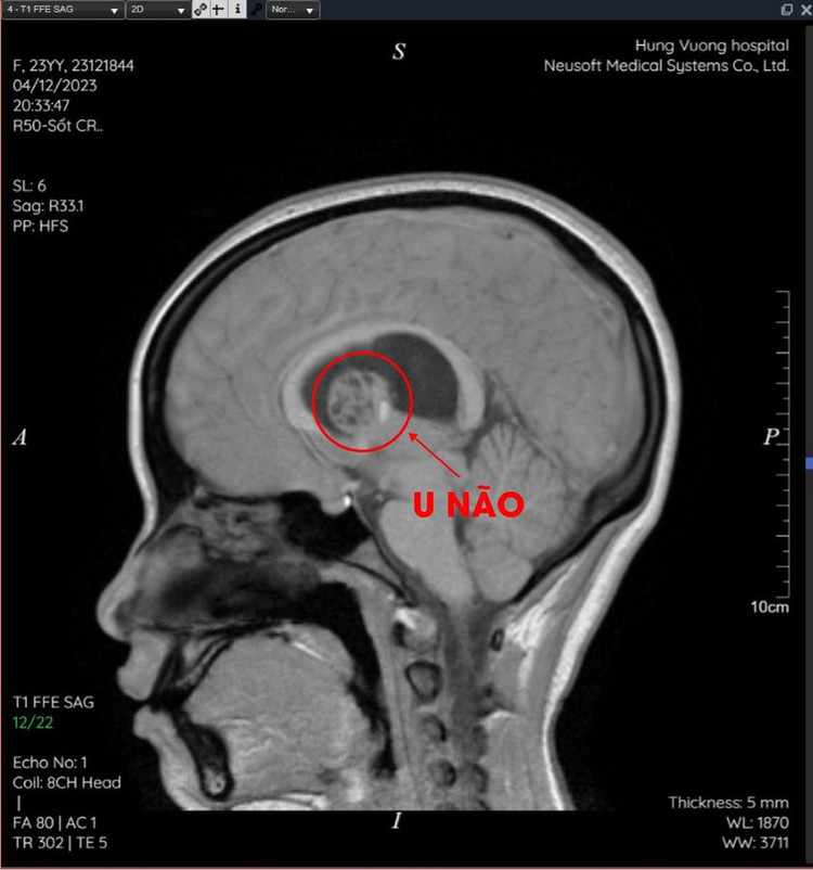 Đau âm ỉ vùng trán, cô gái 23 tuổi phát hiện khối u não nguy hiểm ảnh 1