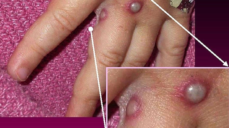 Cách phân biệt bệnh đậu mùa khỉ và tay chân miệng - Ảnh minh họa