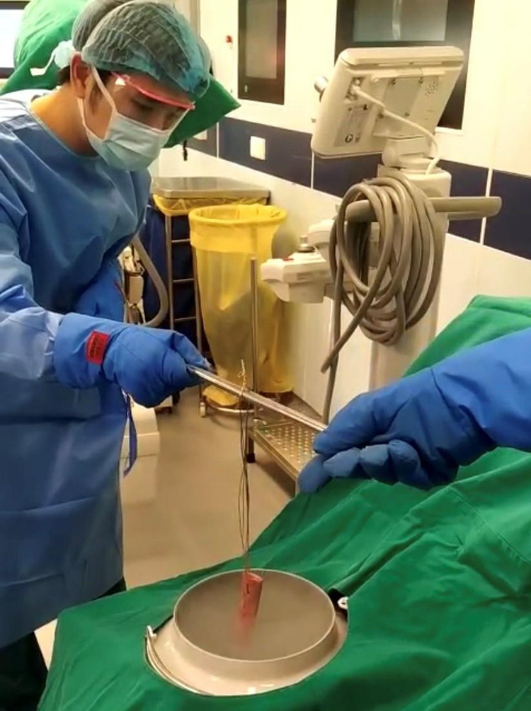 Ngâm xương trong ni tơ lỏng trị tế bào ung thư