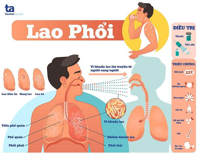 Lao phổi có nên uống thêm 2 tháng thuốc? ảnh 1