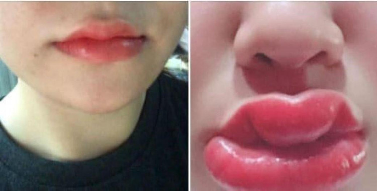 Biến chứng khi xăm môi ảnh 1