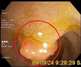 Hình ảnh polyp đại tràng của chị N. (vùng khoanh tròn màu đỏ) - Ảnh BVCC Hình ảnh polyp đại tràng của chị N. (vùng khoanh tròn màu đỏ) - Ảnh BVCC