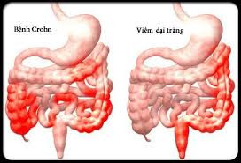 Viêm ruột - Ảnh BVCC