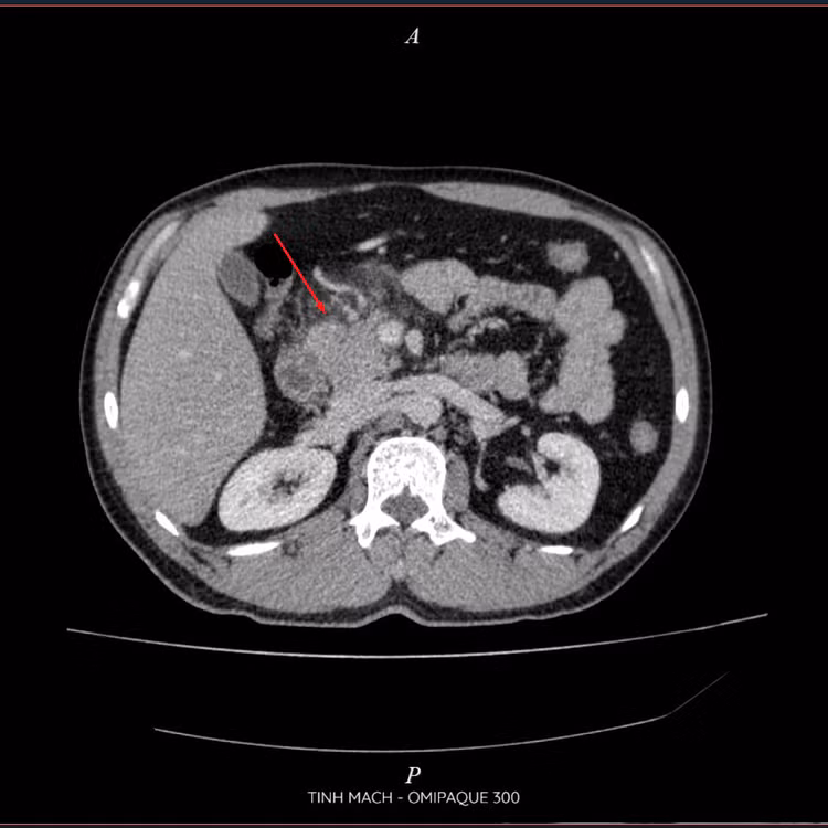 Lọc máu liên tục, cứu bệnh nhân viêm tụy cấp do máu trắng như mỡ ảnh 2