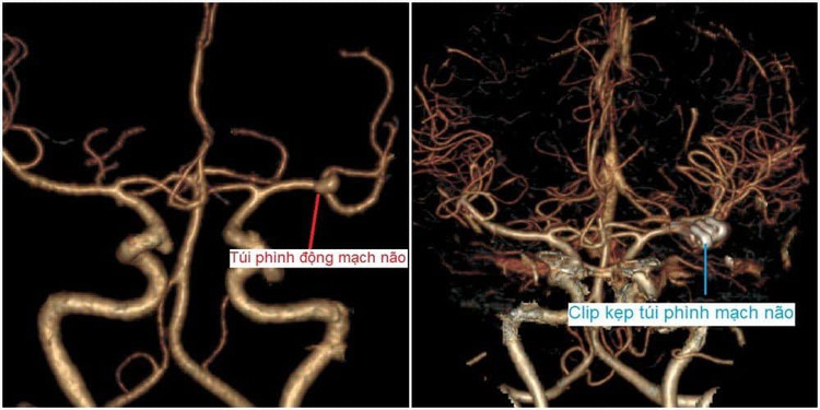 Hình ảnh dị dạng mạch máu phức tạp trên phim chụp