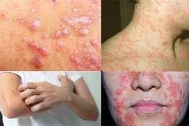 Thời tiết nồm ẩm làm gia tăng các bệnh về da - Ảnh minh họa