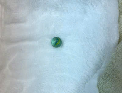 Viên bi sau khi được gắp ra khỏi dạ dày của bệnh nhi - Ảnh BVCC