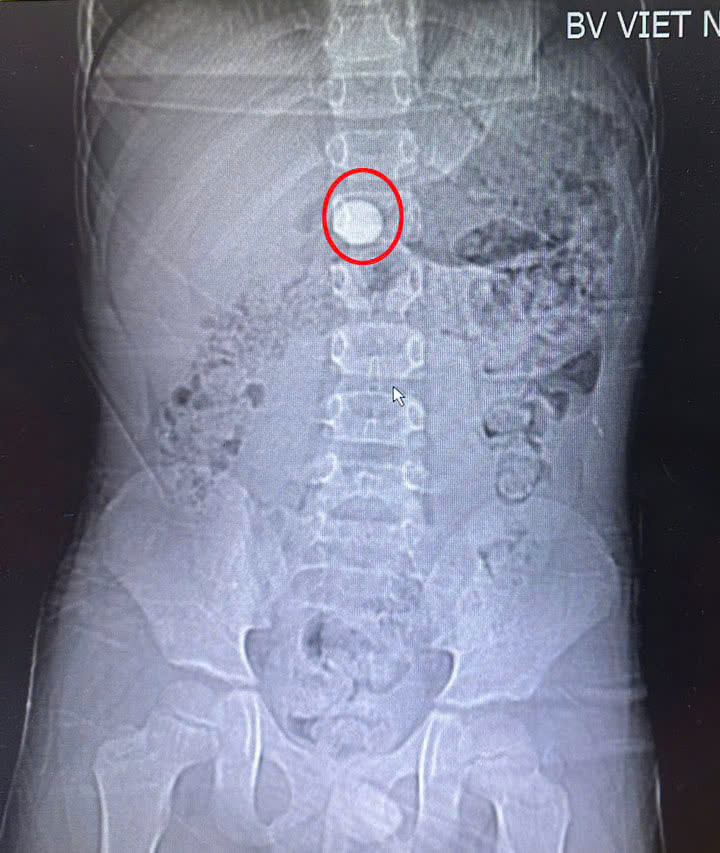 Hình ảnh dị vật trong dạ dày của bệnh nhi - Ảnh BVCC