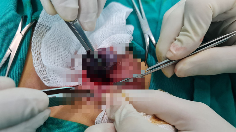 Phẫu thuật xoắn tinh hoàn cho trẻ - Ảnh BVCC