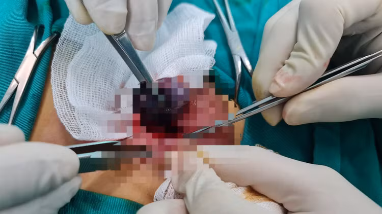 Phẫu thuật xoắn tinh hoàn cho trẻ - Ảnh BVCC