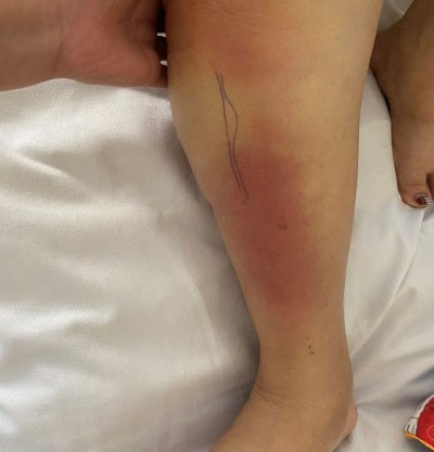 Bệnh nhân bị biến chứng sau tiêm khớp không an toàn