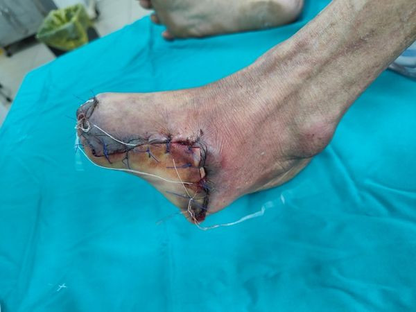 Quấn thuốc đông y trị tê chân, bệnh nhân phải cắt bàn chân vì bỏng ảnh 1