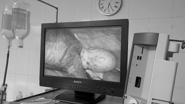 Nội soi tách u bì buồng trứng xoắn bảo toàn thai nhi 20 tuần.