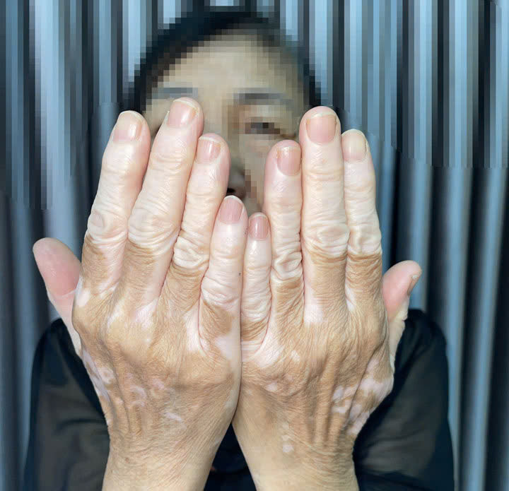 Một trường hợp mắc bệnh bạch biến đến khám tại Bệnh viện - Ảnh BSCC Một trường hợp mắc bệnh bạch biến đến khám tại Bệnh viện - Ảnh BSCC