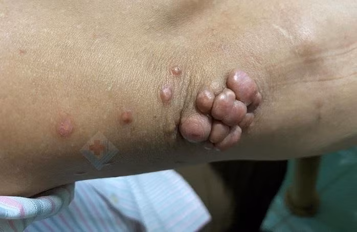 Bệnh nhân mắc u vàng thể cục.