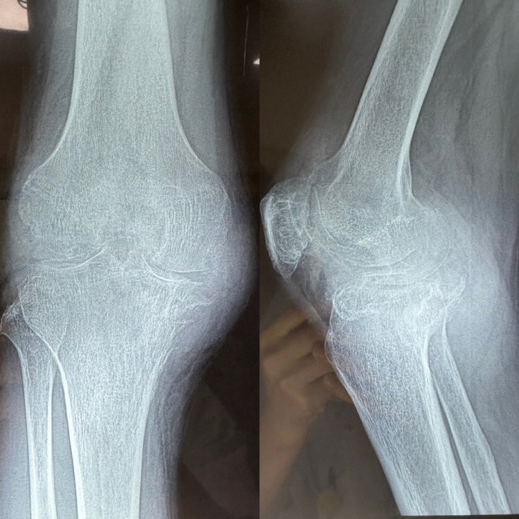 Các hạt tophi phát triển ngày càng lớn phá hủy hết khớp bệnh nhân