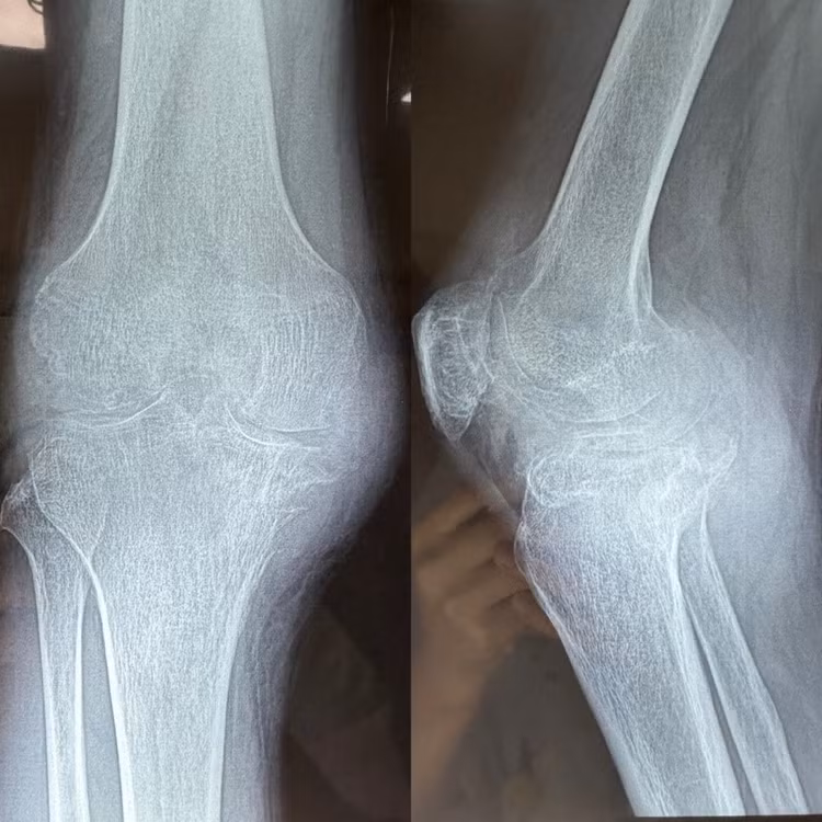 Các hạt tophi phát triển ngày càng lớn phá hủy hết khớp bệnh nhân